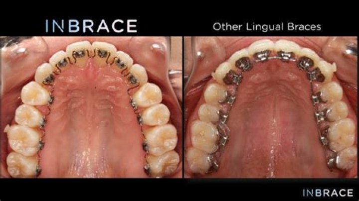 Are lingual braces better than normal braces?