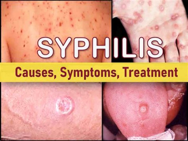 Can you naturally get rid of syphilis?