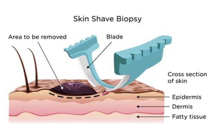 Do you need to shave before a laparoscopy?