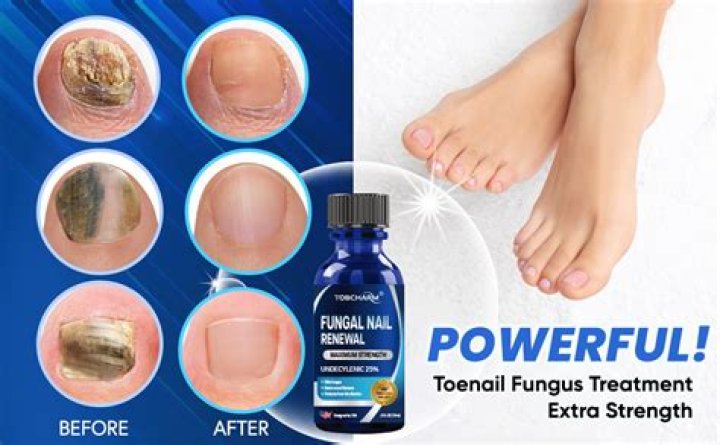 Does Nonyx cure toenail fungus?