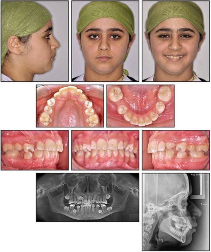 Is missing permanent teeth genetic?
