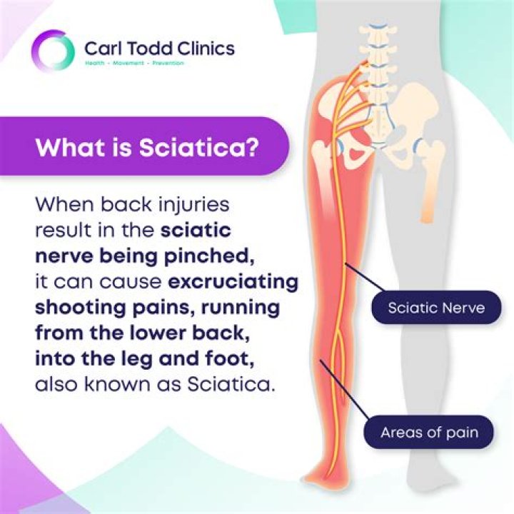 What does sciatica feel like in leg?