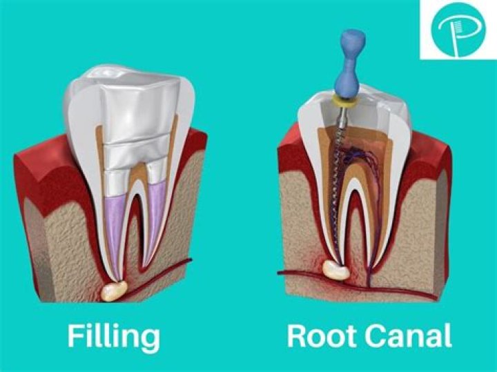 What is the most common cause of root canal failure?