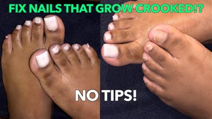 What makes your toenails grow crooked?