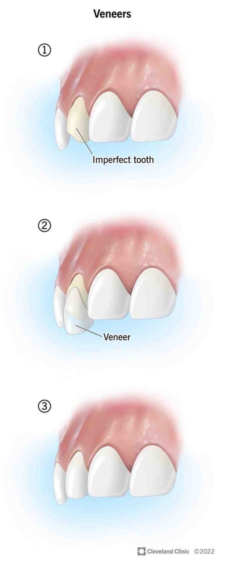 Who is not a candidate for veneers?